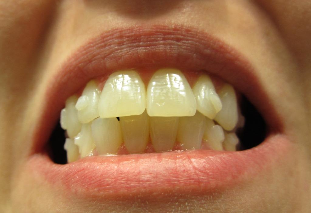 Протезы передних зубов