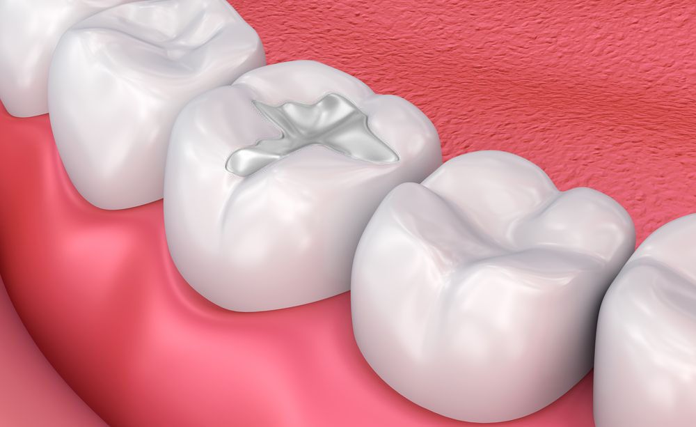 Композитные стоматологические пломбы