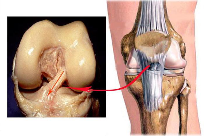 воспаление связок коленного сустава