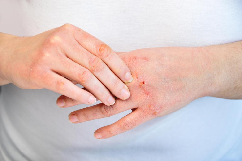 как проявляется аллергия на руках