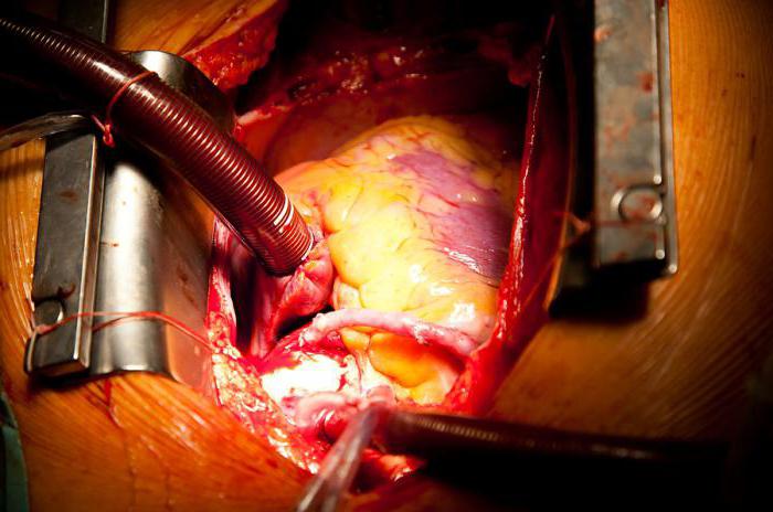 миксома сердца операция