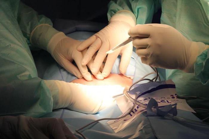 операция по удалению миксомы сердца