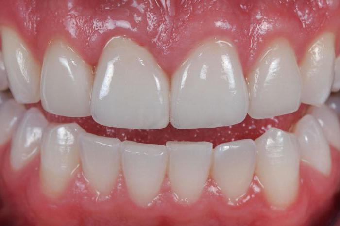 зубы керамические