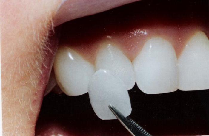 керамические виниры на зубы 