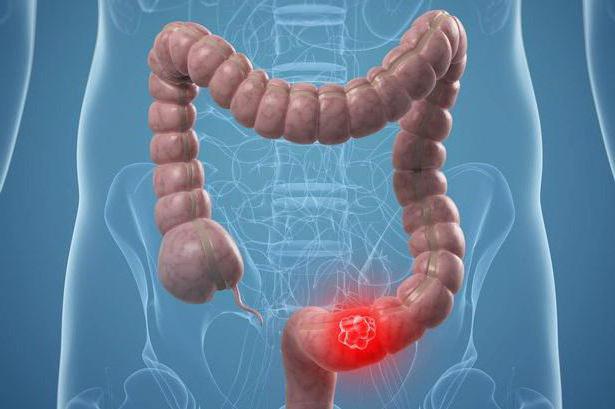 высокодифференцированная аденокарцинома кишечника 