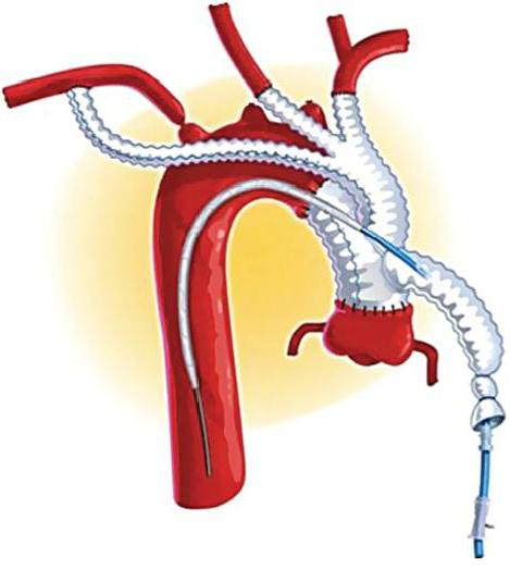 эндоваскулярная хирургия позвоночной артерии 