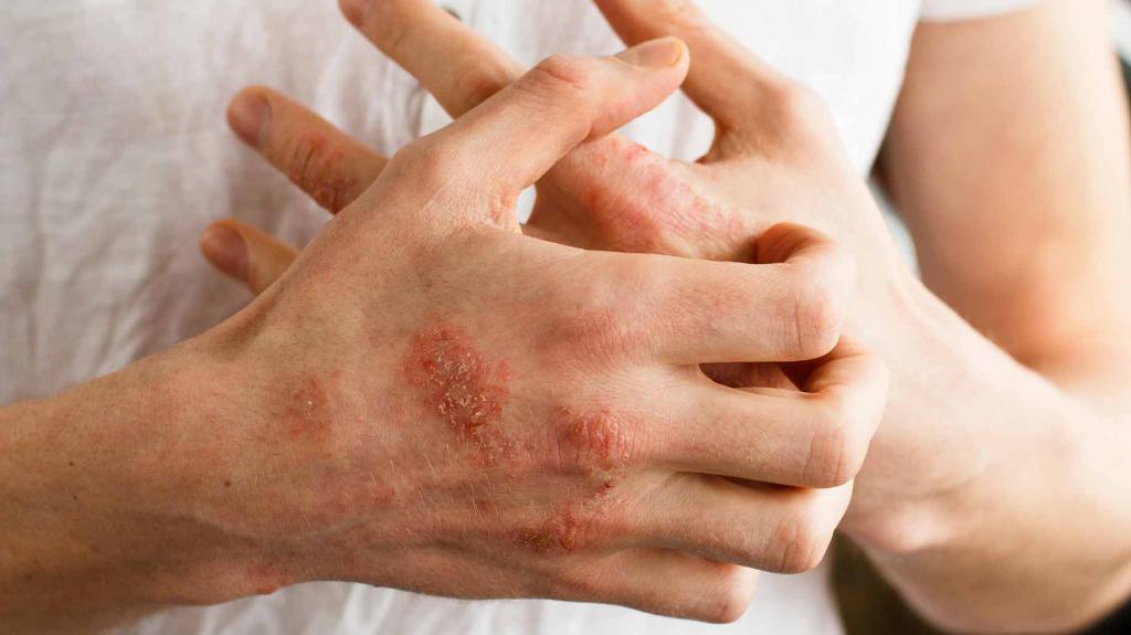 заразен ли псориаз кожи