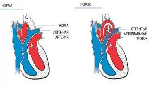 У ребенка открытые артериальные протоки