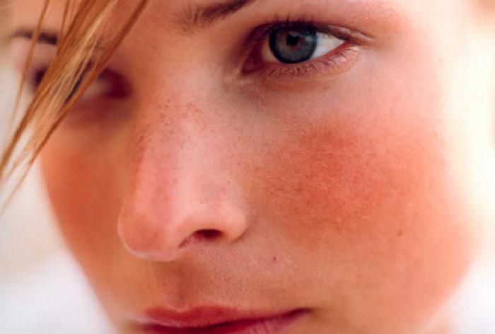 Причины купероза на лице и способы лечения