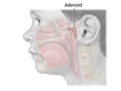 стоит ли удалять аденоиды ребенку