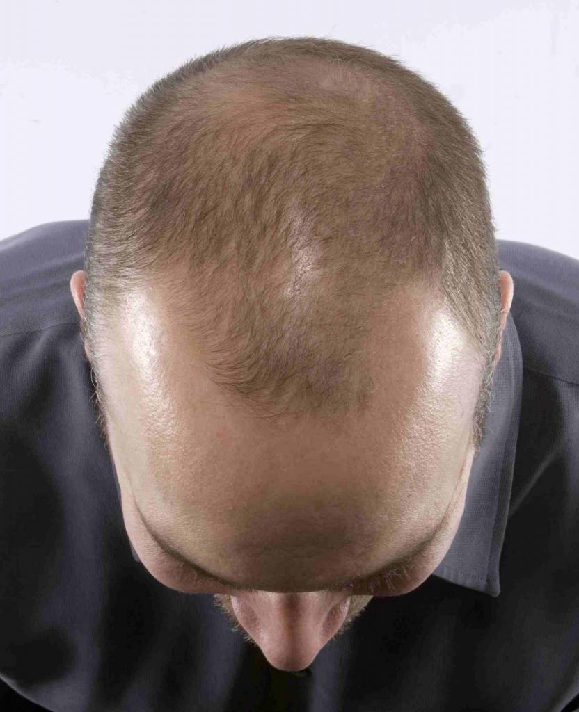 Скорость роста волос на голове у мужчин и способы стимуляции