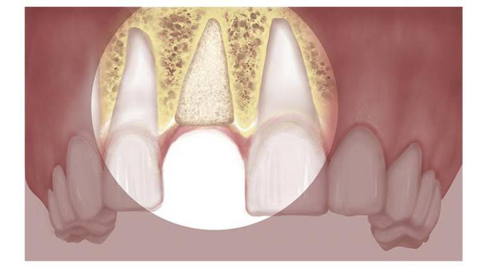 Костная пластика при имплантации зубов отзывы