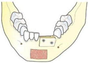 Костная пластика при имплантации зубов что это