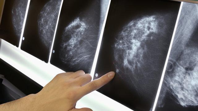 как определить рак груди у женщин