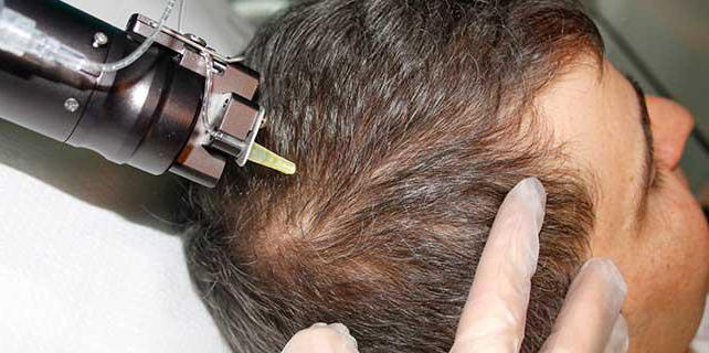 фракционная мезотерапия волосистой части головы