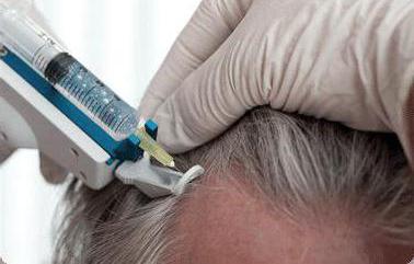мезотерапия волосистой части головы