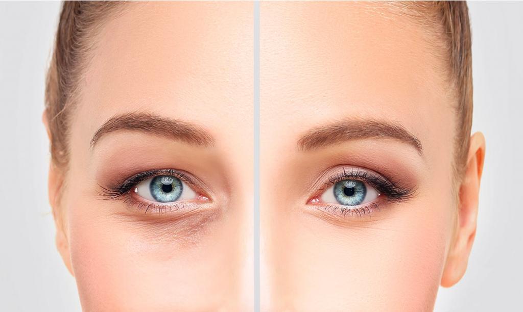 Биоревитализация вокруг глаз: понятие, назначение, особенности проведения, результаты до и после с фото