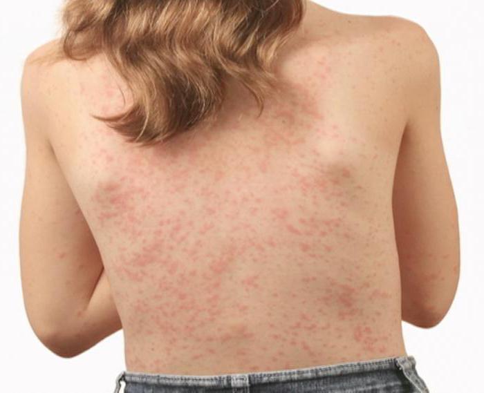крем от аллергии на коже у взрослых эффективность