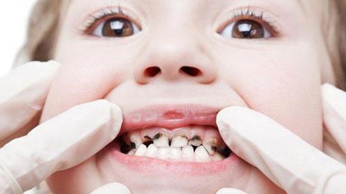скученность зубов нижней челюсти