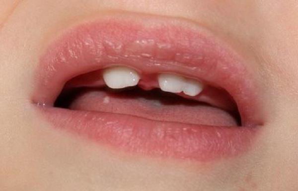 Как отличить молочный зуб от коренного у ребенка?