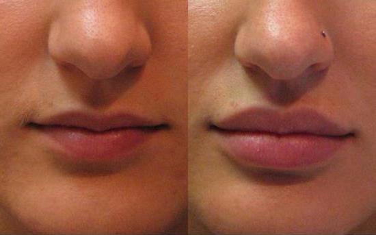 ботулотоксин в косметологии фото до и после
