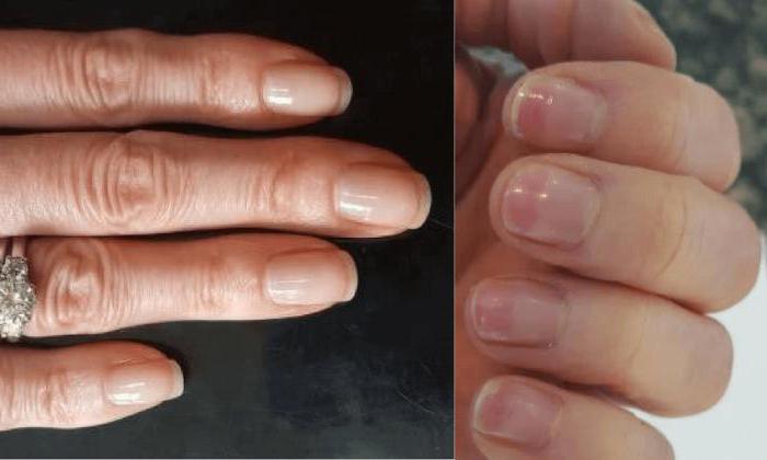 Как укрепить ногти после гель-лака? Ломкие ногти