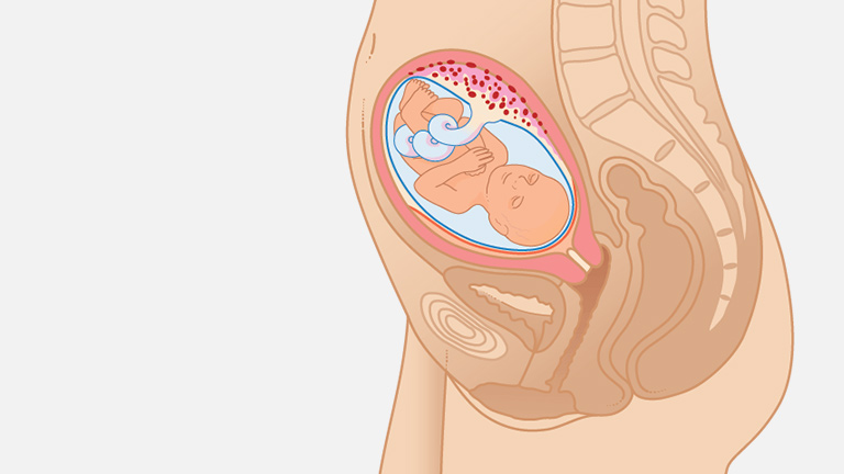 Что значит БПР на УЗИ при беременности