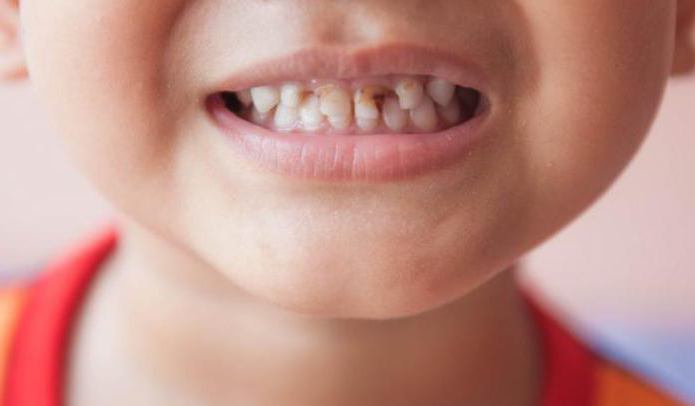 черные зубы у детей фото