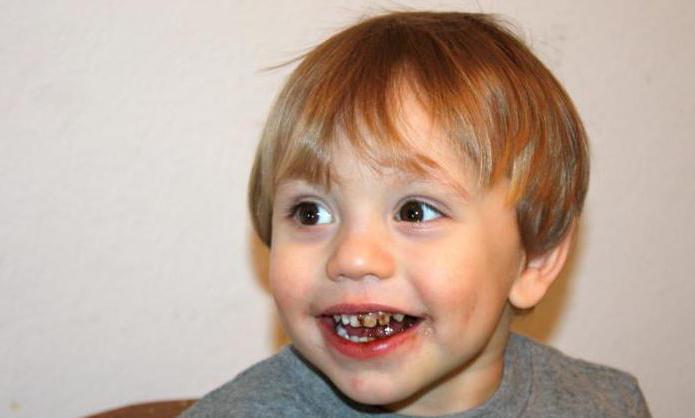 черные зубы у ребенка