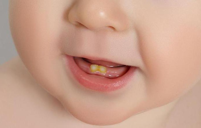 почему у ребенка черный налет на зубах