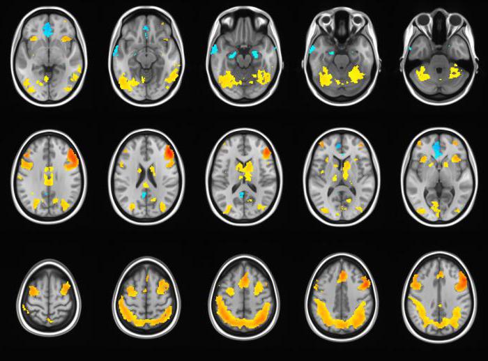 Расшифровка МРТ мозга