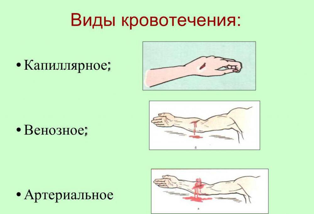 Пальцевое прижатие артерий