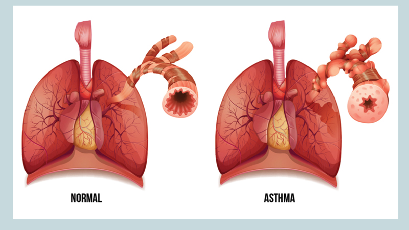 Бронхиальная астма неатопическая - Бронхиальная астма