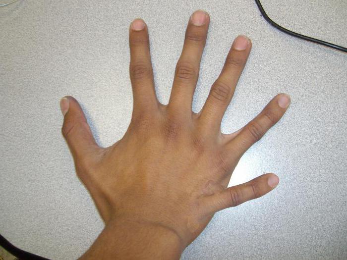 ребенок с шестью пальцами на руке