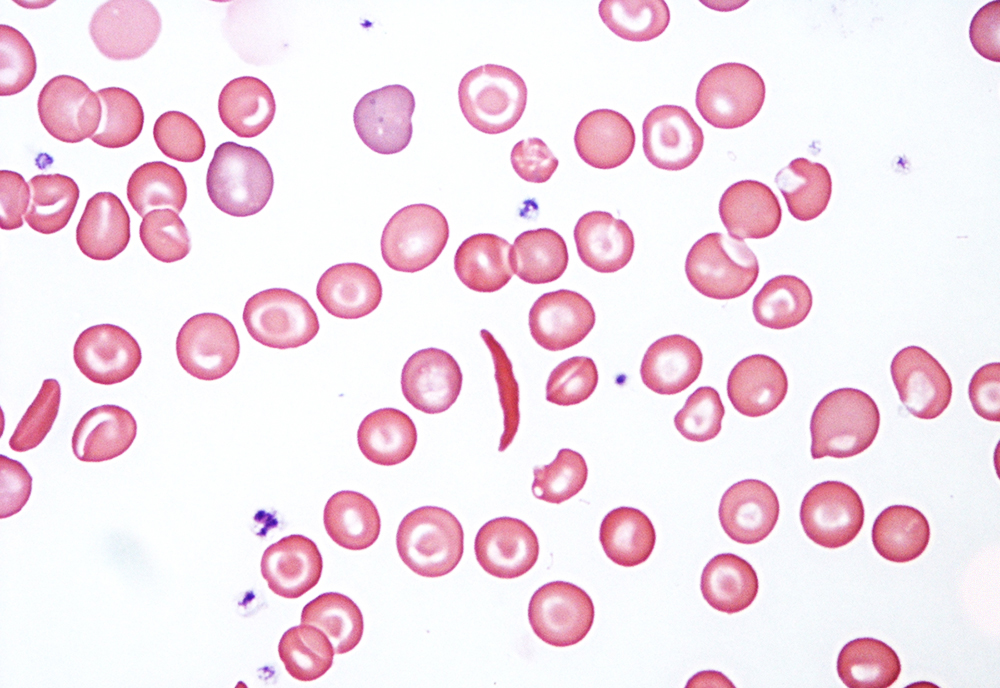 Серповидноклеточная анемия у человека.