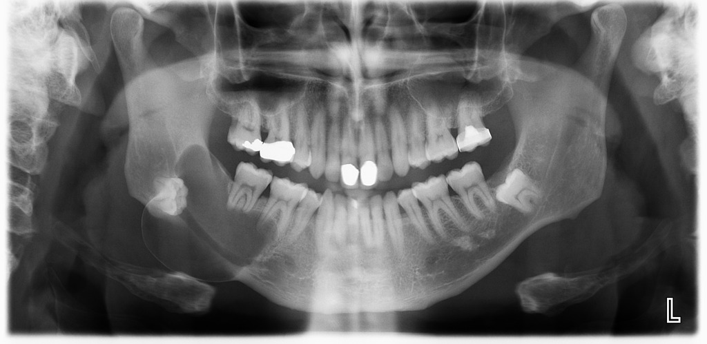 удаление кисты зуба нижней челюсти