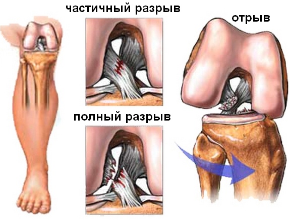 разрыв связок мениска коленного сустава