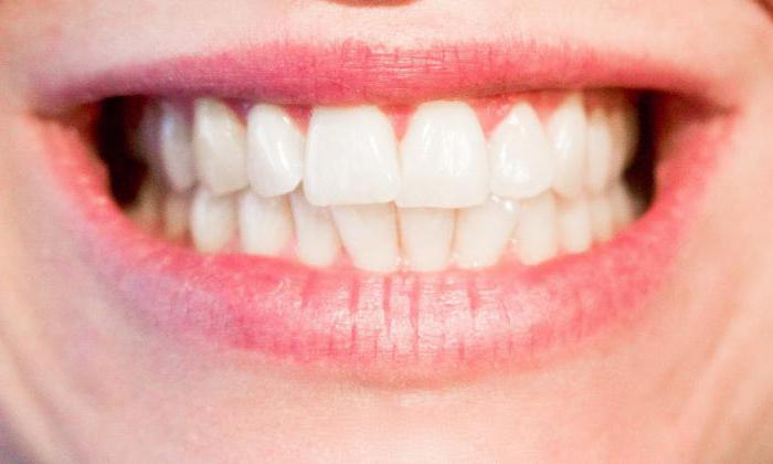 гипоплазия эмали зубов фото 