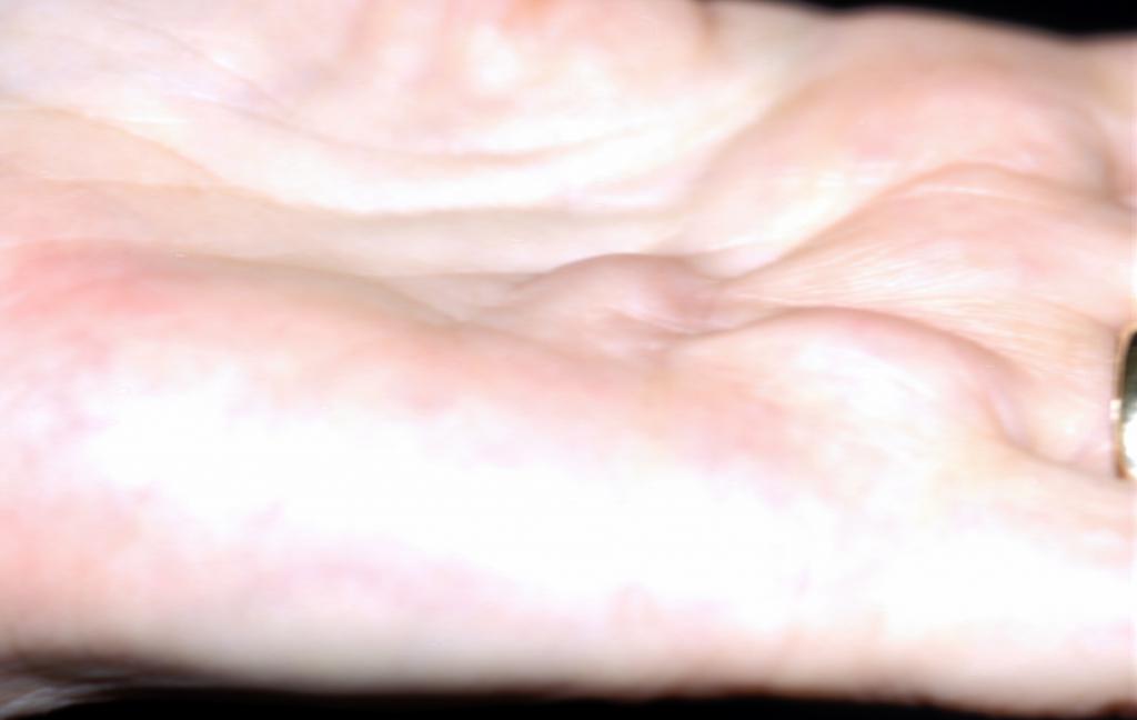 опухоль кожи фото на руке