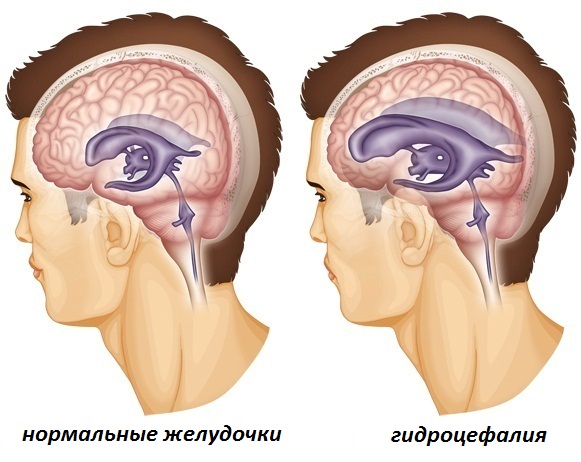 наружная гидроцефалия мозга