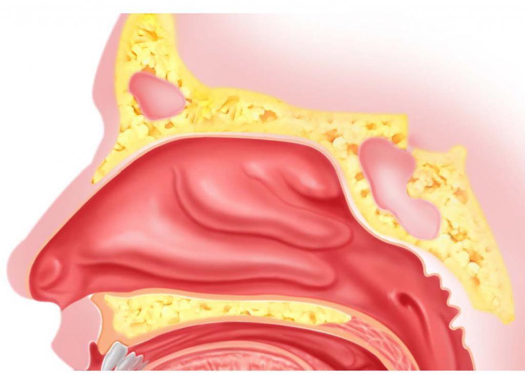 полость носа при аллергии