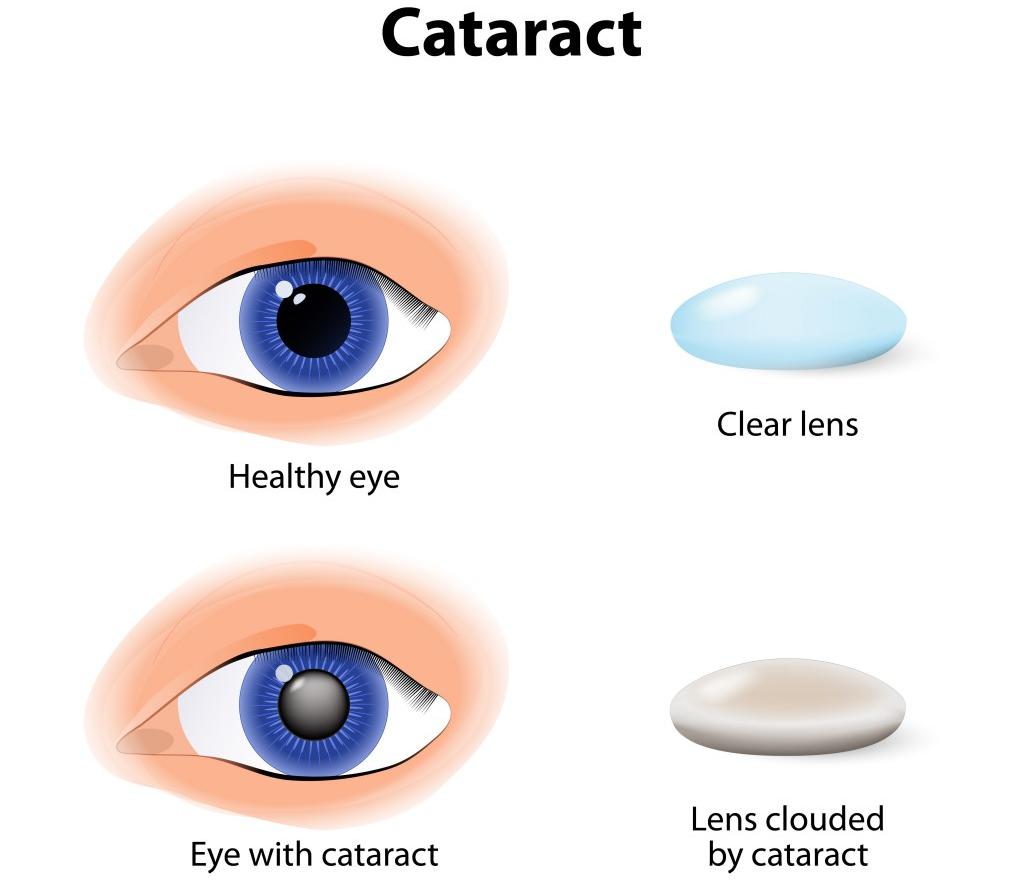 Заболевание катаракта