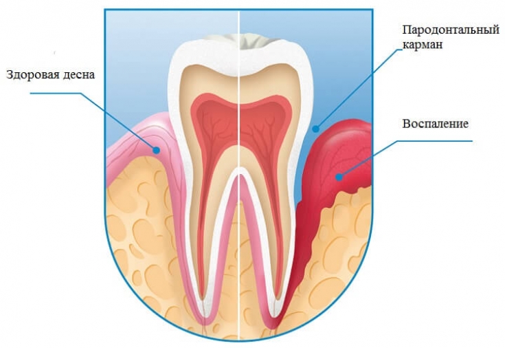Воспаление десны