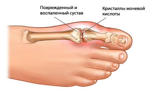 Поврежденный сустав