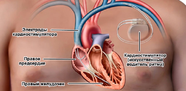 Установка кардиостимулятора