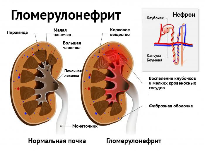 Нормальная и пораженная почка