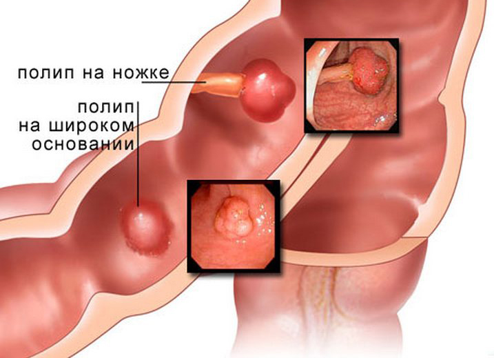 Полипы на ножке