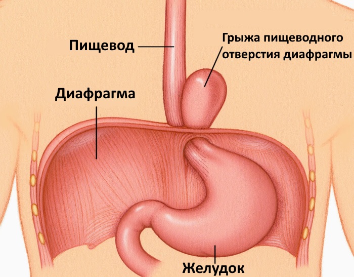 Грыжа Диафрагмы Пищевода Симптомы Лечение Диета