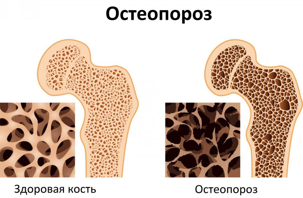 Здоровая и больная кость