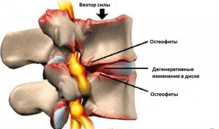 Поражение позвонков